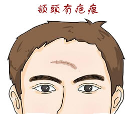 身体哪些部位不宜见到疤痕