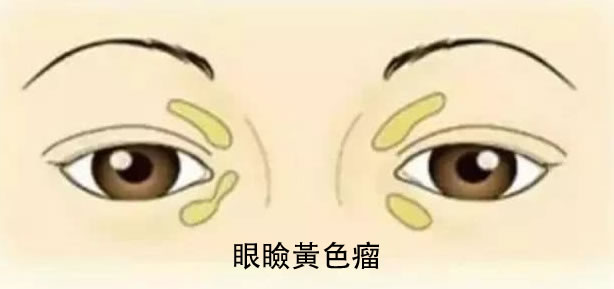 心脏好不好，看脸就知道！有这几种“长相”的人危险了！